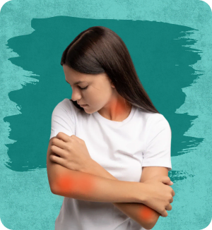 Chronic Spontaneous Urticaria (Hives)