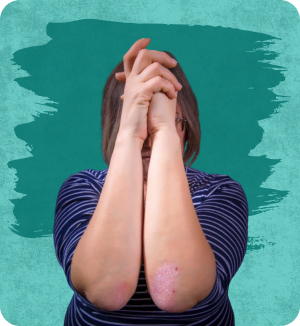 Psoriasis