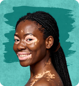 Vitiligo